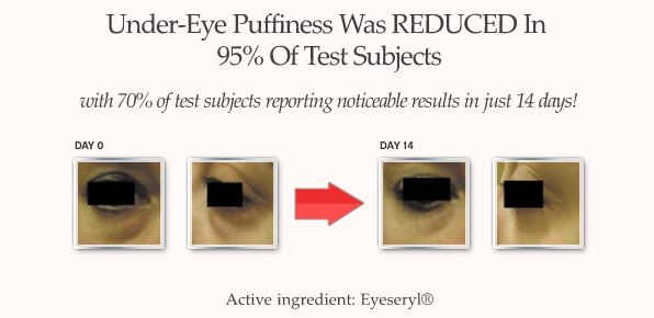 eyelasticity-before-after