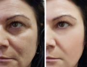 Genf20 Plus Before And After