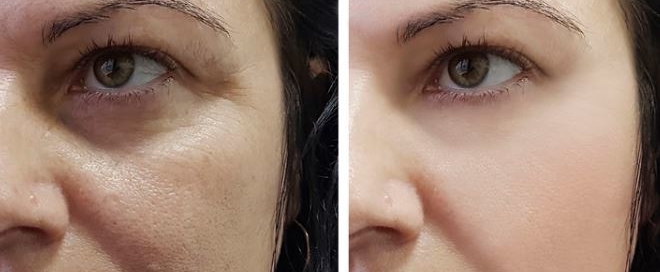 Genf20 Plus Before And After