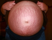 Pregnancy Stretch Marks