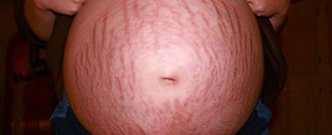 Pregnancy Stretch Marks