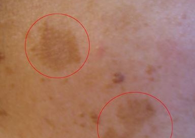 Melasma