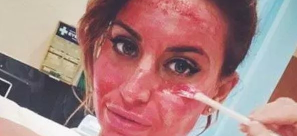 The Vampire Facial
