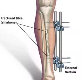 Limb Lengthening Surgery