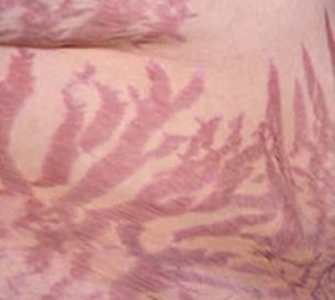 Severe Stretch Marks
