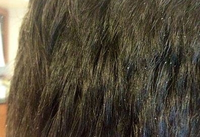 Dandruff