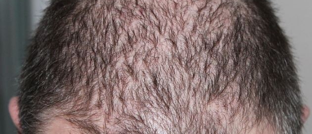 Male Hair Loss