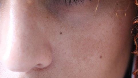 Melasma