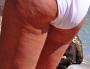 Cellulite