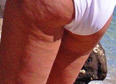 Cellulite