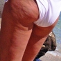 Cellulite: Risk Factors, Causes and Treatments