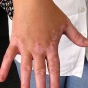 Vitiligo Facts: Causes, Symptoms, Treatment and Makeup